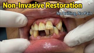 Non-Invasive Partial Denture Restoration | No Drilling#PartialDenture  #DentalRestoration#Dental