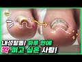 (eng sub)내성발톱! 하루 만에 쫙 펴고 싶은 사람!｜레푸스 서면점/사상점｜ingrown toenail｜Athlete&#39;s foot-Fresh Foot