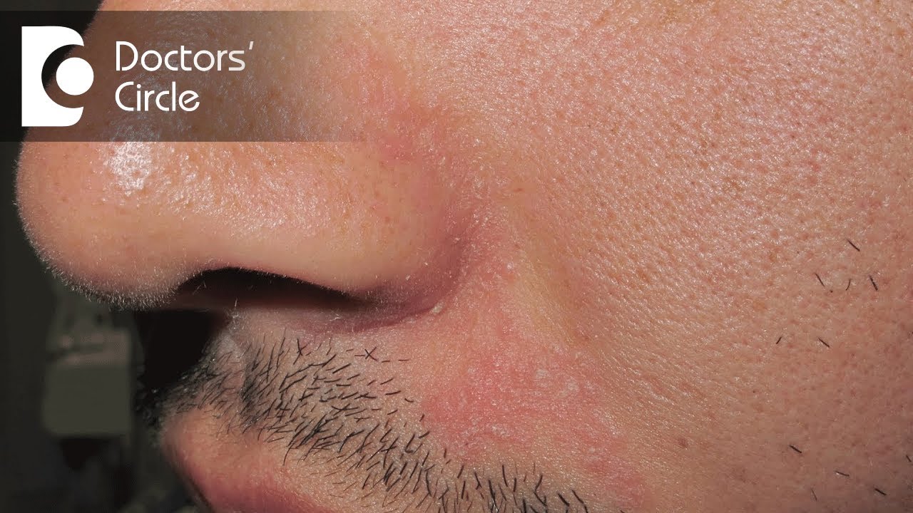 Is Lupus a hereditary disease Can you catch Lupus disease? Dr