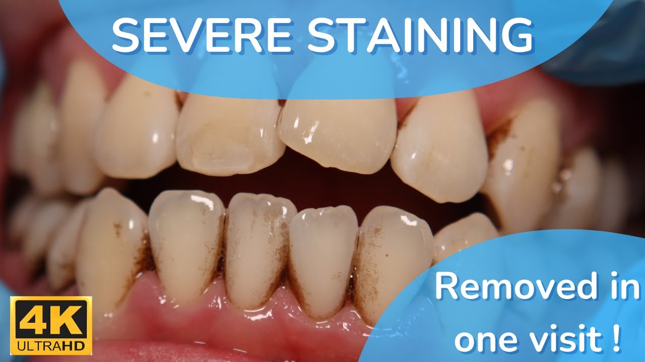 how to remove tobacco stains from teeth reddit Amazing Results Stain and Tartar Removal Just in One Visit [20M Smoker]