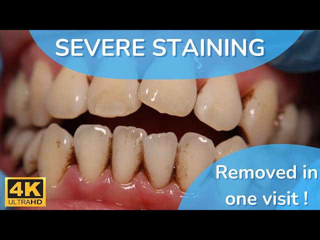 before and after tobacco stains on teeth Pan & (Smokers) Treatment | & | Dental Case # 32 Teeth Whitening for Smokers: Removing