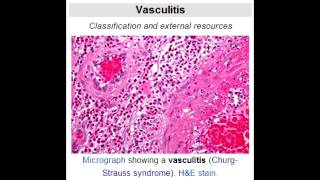 Lab Or Diagnostic Findings Vasculitis Wegeners, Microscopic Polyangiitis, Churg-Strauss Syndrome