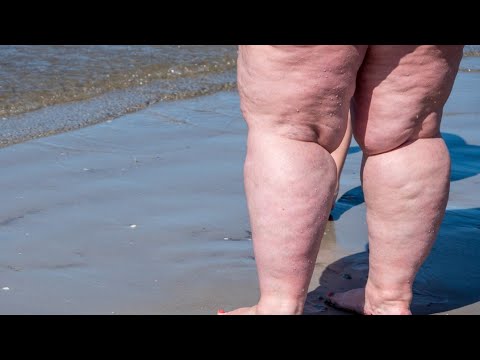 Que es el lipedema en piernas