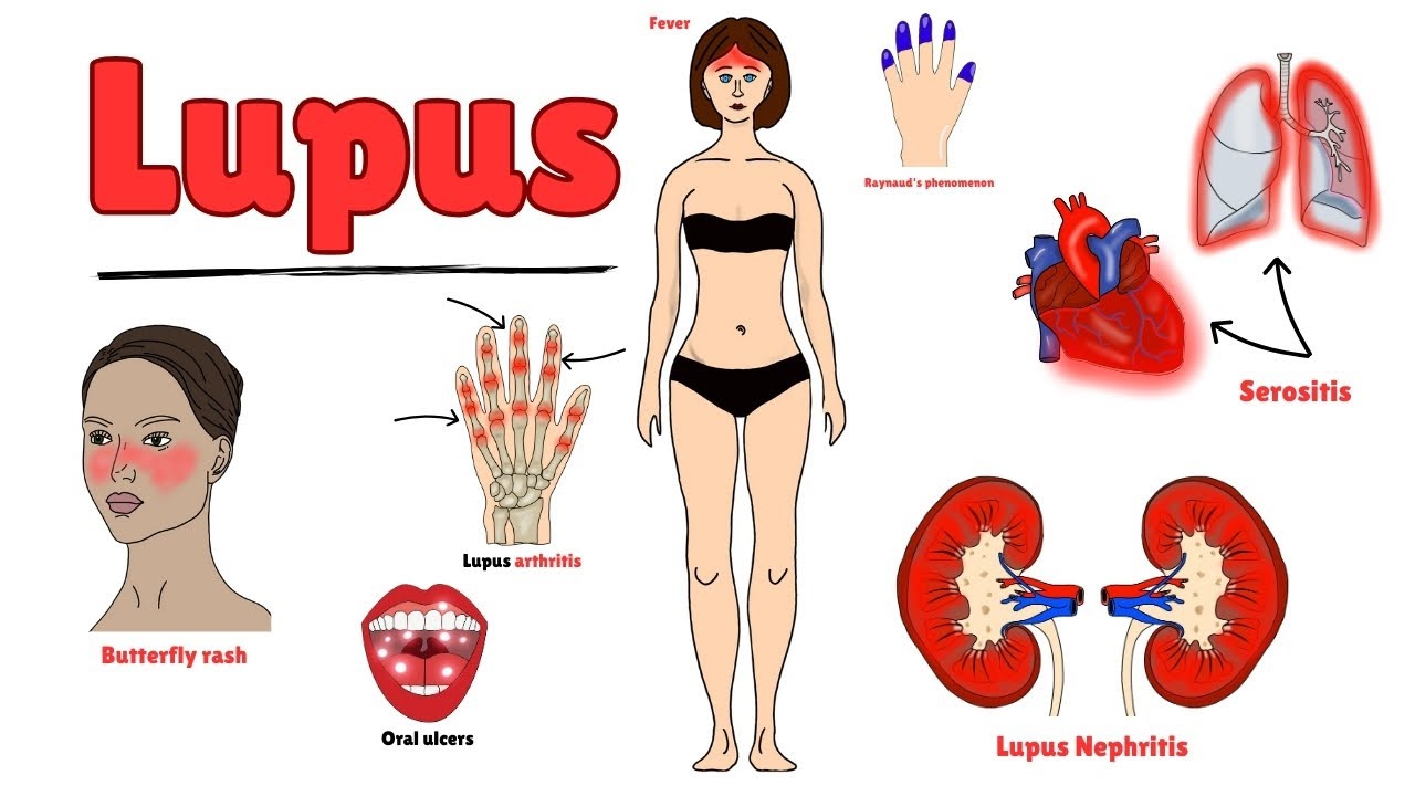 semaglutide induced lupus causing