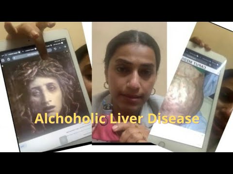 Alcoholic Liver Disease- Full video