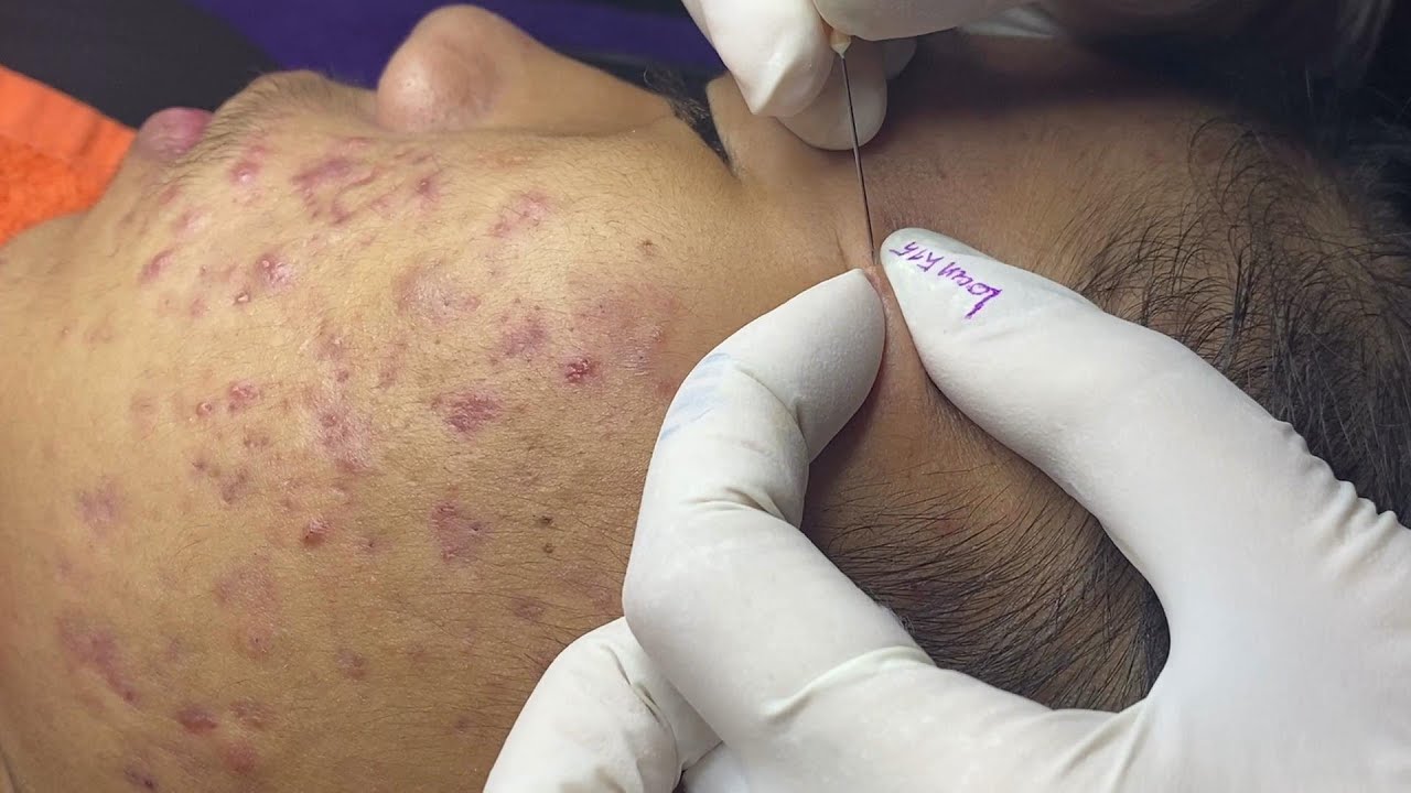 Loan Nguyen Acne (#074)