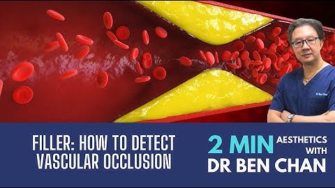 Filler complication: Vascular Occlusion or Bruise? Part 2