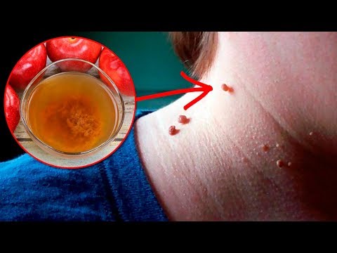 How To Remove Skin Tags Naturally At Home