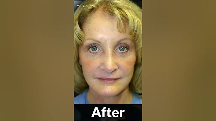 Brow Lift, Rhinoplasty, Facelift - 60 Year Old Patient #facelift