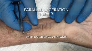 Parallel Laceration Repair