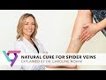Medical Center: Natural Cure for Varicose Veins | Top Vein Expert New York 10016
