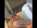 Permanent Hair removal with laser in a Skin Clinic Abuja Nigeria.