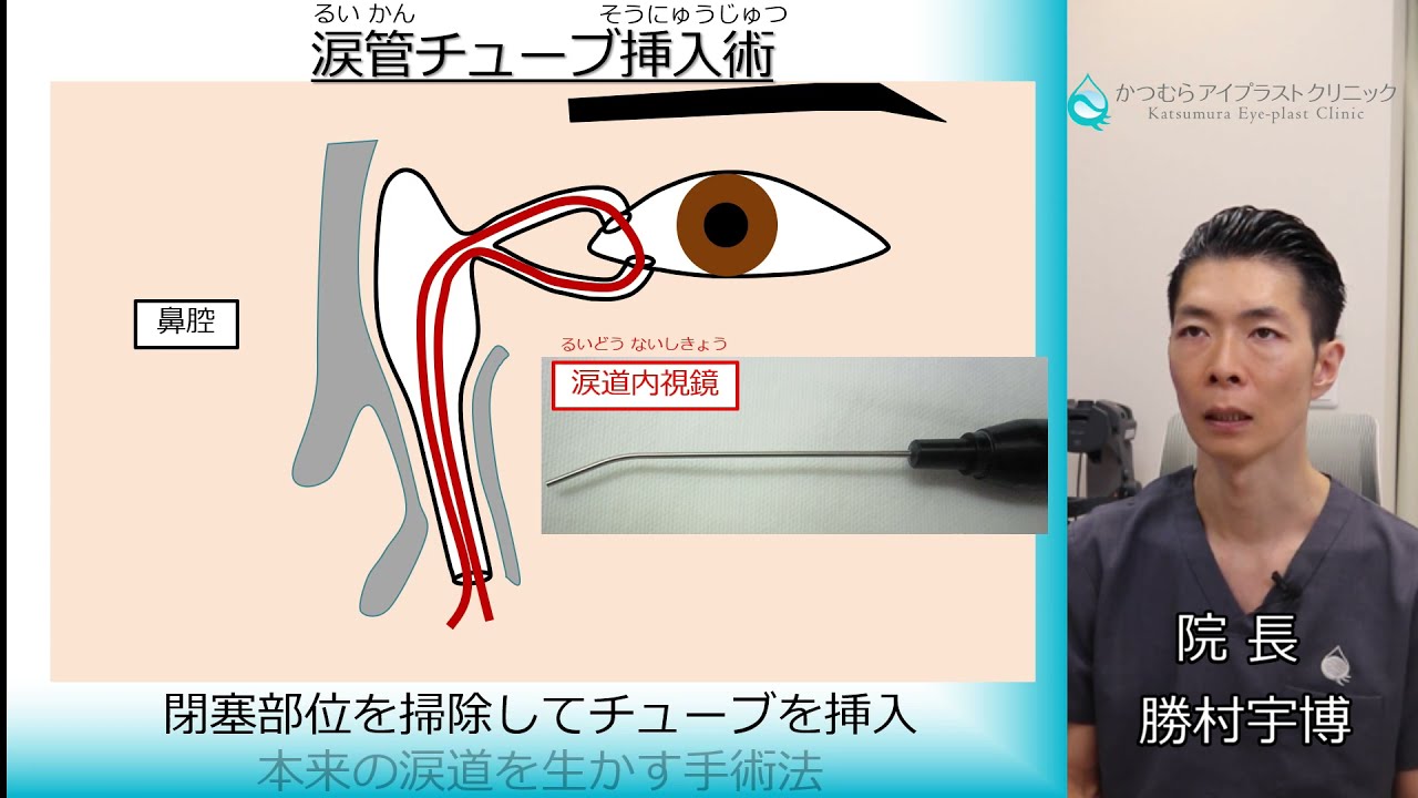 60秒でわかる涙道閉塞】③治療（涙管チューブ挿入術） - YouTube