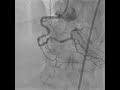 Delivering stent through a tortuous rca