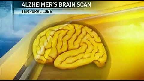 Washington Radiology MRI NeuroQuant interview with Dr Lande - 3/4/2010
