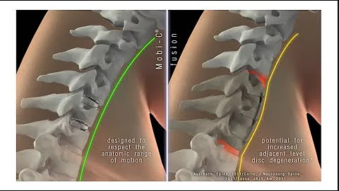 Dr. Loguidice and the Mobi-C Cervical Spine Disc