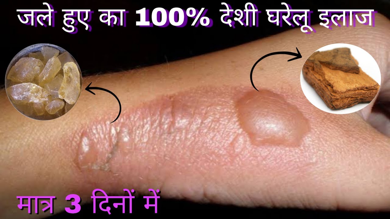 जले हुए का घरेलू रामबाण इलाज मात्र 3 दिनों में // Burns treatment in