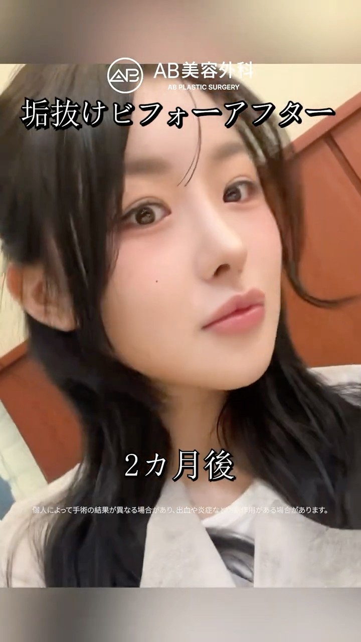 輪郭３点・目整形・鼻整形で垢抜け大成功✨ #Shorts