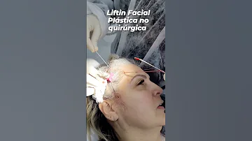 ¿Un lifting facial tensa el cuello?