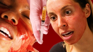 Women Get Facials With Their Own Blood