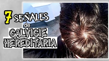 ¿El pelo fino es genético?