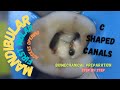 access opening in mandibular first molar with mesial caries | c shaped canals