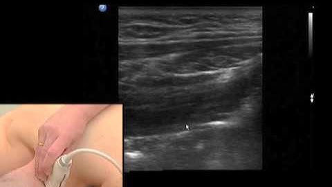 Greater Occipital Nerve Block