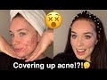 WHAT FOUNDATION COVERS ACNE?!?