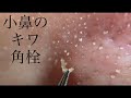 小鼻のキワの角栓収穫！blackheads