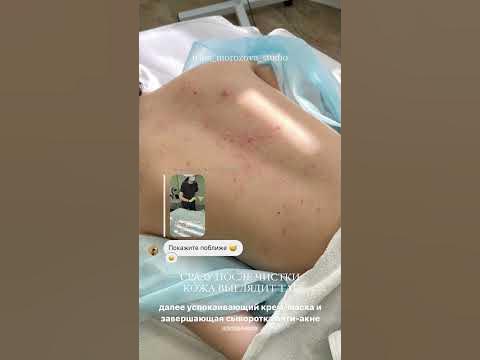 ЧИСТКА спины от акне. - YouTube