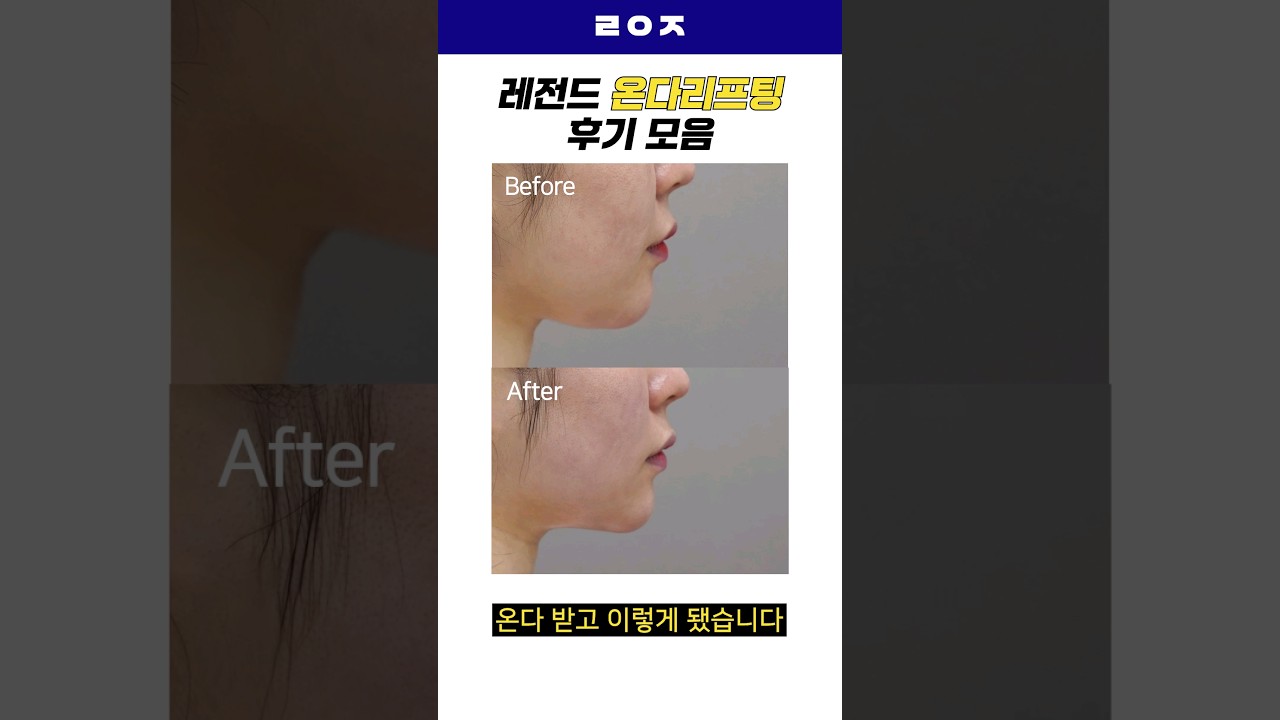 [Лиенжанг гоо сайхны мэс заслын эмнэлэг] Онда лифтинг үйлчилгээний сэтгэгдэл #шортс #ОндаЛифтинг #ЛифтингҮйлчилгээ #ЛифтингСэтгэгдэл #ДавхарЭрүү #ДомогтБичлэг #СолонгосГооСайхан