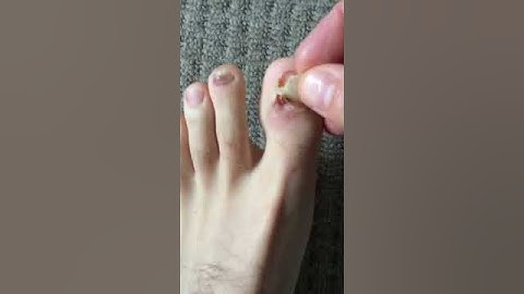 Runners toenail must see