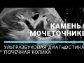 КАМЕНЬ В МОЧЕТОЧНИКЕ на УЗИ 😖 ПОЧЕЧНАЯ КОЛИКА ▶️ URETERAL STONE ULTRASOUND