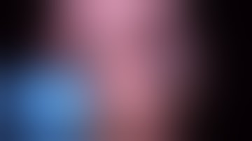 Laparoscopic cholangiography with excision of ‘forme fruste’ choledochal cyst with Roux-en-Y HJ