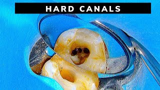 Getting Down Tough Curved Canals (Root Canal Treatment)