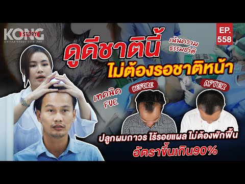 ปลูกผมถาวร ไร้รอยแผล ไม่ต้องพักฟื้นอัตราขึ้นเกิน 90% | Kong Story EP.558