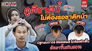 ปลูกผมถาวร ไร้รอยแผล ไม่ต้องพักฟื้นอัตราขึ้นเกิน 90% | Kong Story EP.558