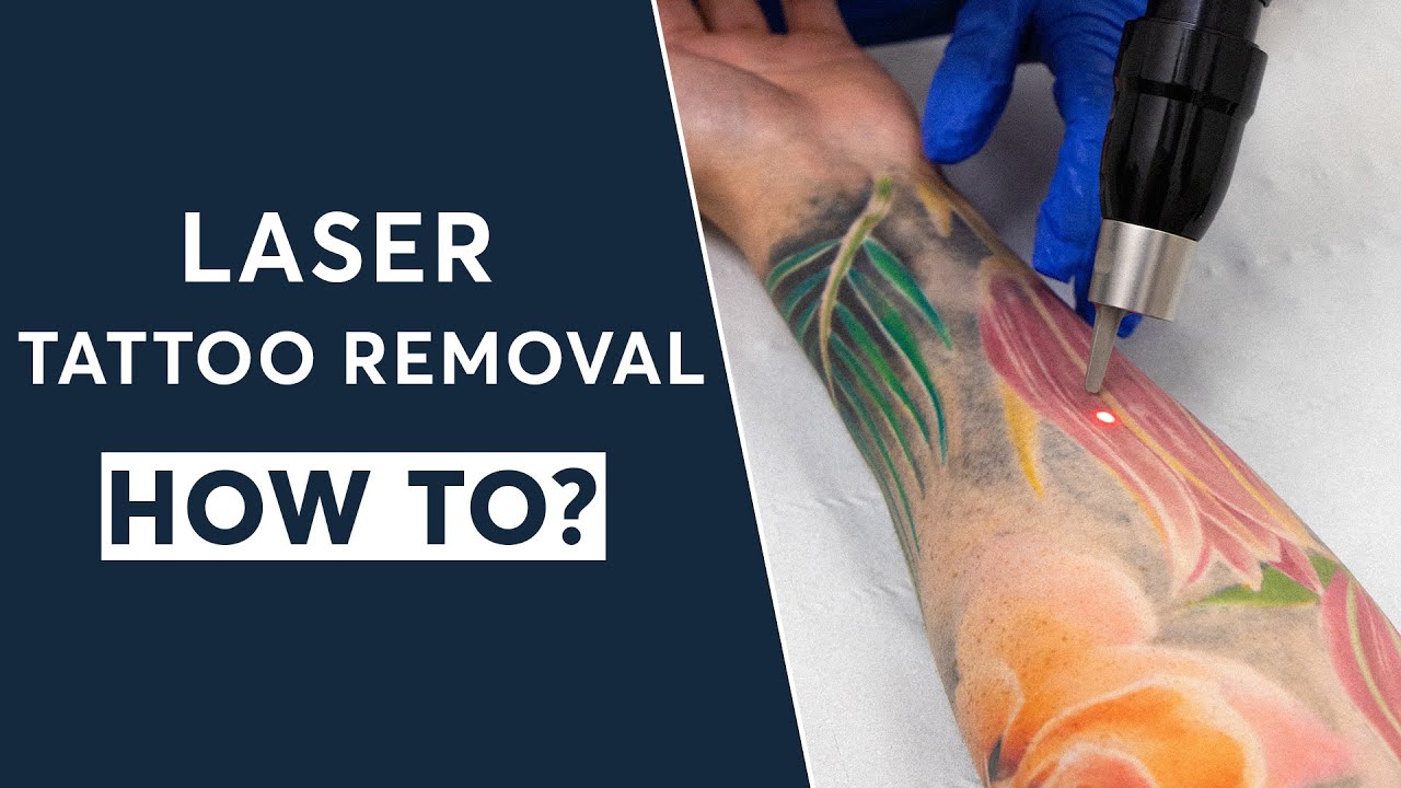 Laser Tattoo Removal Atlanta | Tattoo Removal Benefits, Recovery, Results