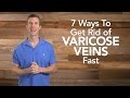 7 Ways to Get Rid of Varicose Veins Fast | Dr. Josh Axe