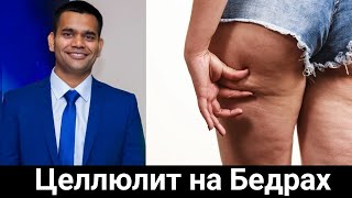 Как убрать целлюлит на бедрах? Доктор Вивек