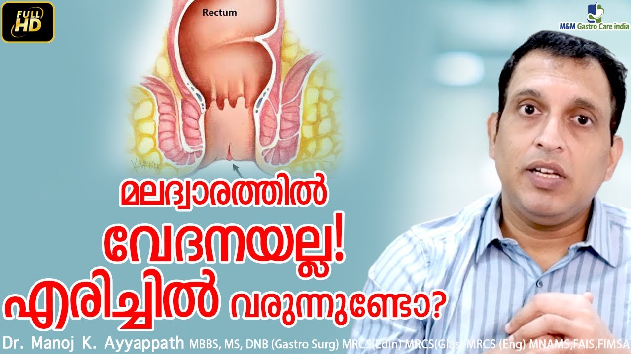 മലദ്വാരത്തിൽ വേദനയല്ല! എരിച്ചിൽ വരുന്നുണ്ടോ? | M&M Gastro Care India | Dr Manoj Kumar Ayyappath