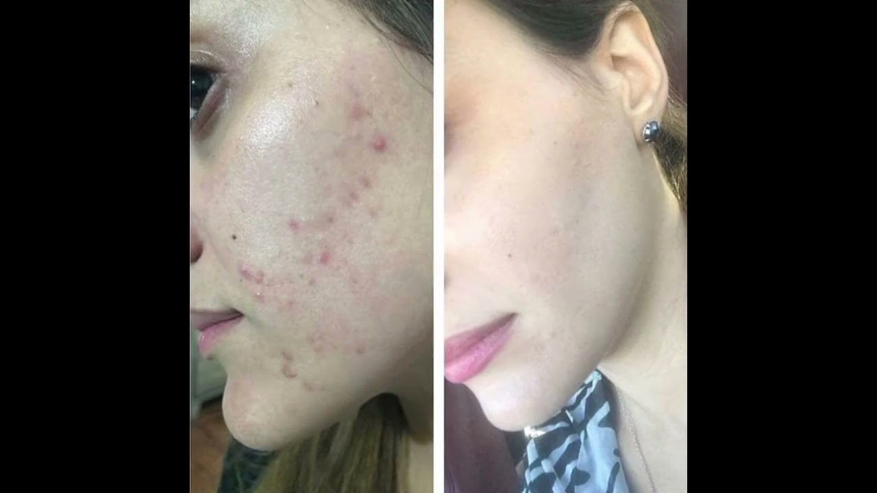 Barirar repair skincare #skincare#beauty#glowing#