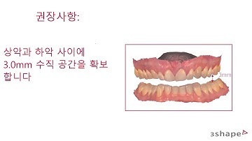 3Shape 트리오스 - 구강 수면 장치용 TRIOS 스캔 가이드 - Scan guide for oral sleep appliances