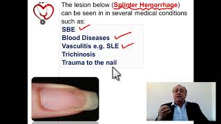 Splinter hemorrhage #cme #internal_medicine #medical #usmle #pharmaceutical  #doctor #محاضرات_باطنة screenshot 3