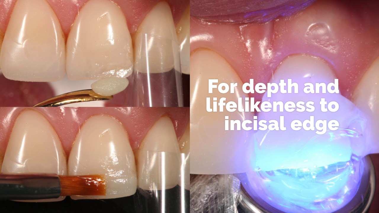 Broken & Sharp Tooth: How to Fix Fast, Repair Options & Cost
