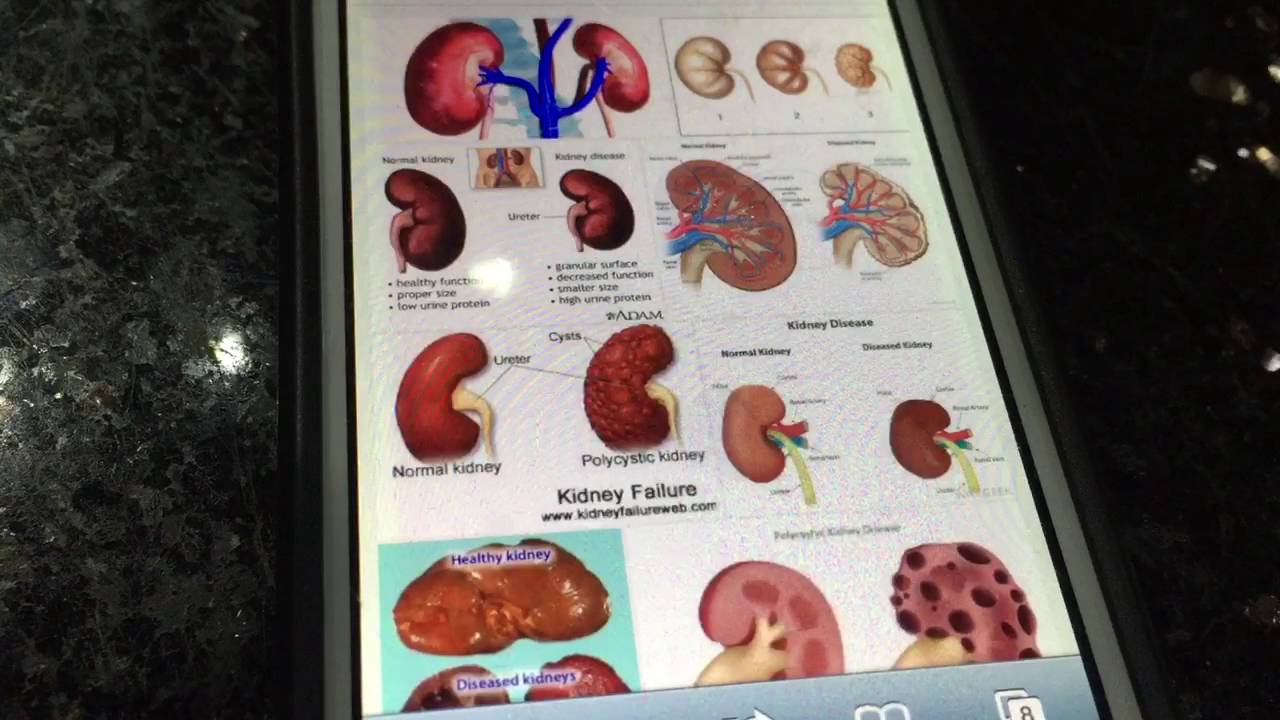 Kidney Transplant YouTube