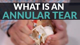 What is an Annular Tear and How Can You Find Relief?