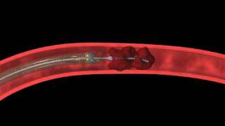 Penumbra Stroke System