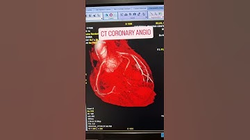 Thumbnail of CT CORONARY ANGIOGRAPHY #bollywood #song #hindisong #radiology #radiographerclasses