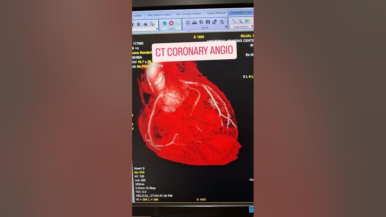 CT CORONARY ANGIOGRAPHY #bollywood #song #hindisong #radiology #radiographerclasses